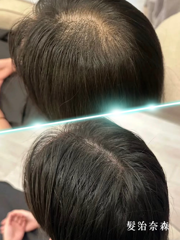 王女士 療程前後對比