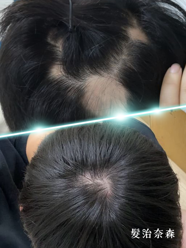 王先生 療程前後對比